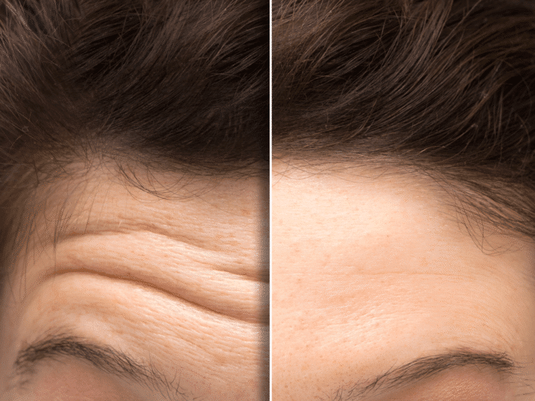 botox-durando-menos