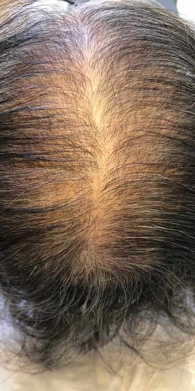 queda-de-cabelo-pos-parto-como-tratar