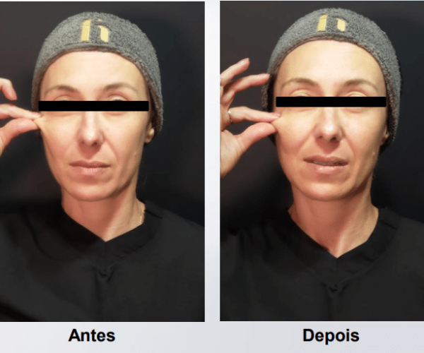 coolfase-antes-depois