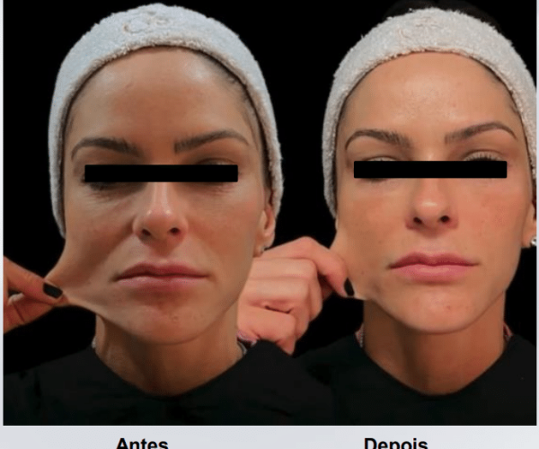 coolfase-antes-depois