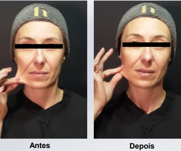 coolfase-antes-depois
