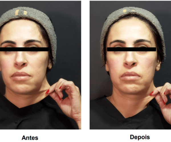 coolfase-antes-depois