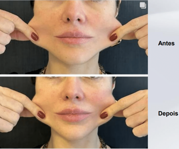 coolfase-antes-depois