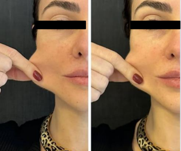 coolfase-antes-depois