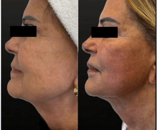 coolfase-antes-depois